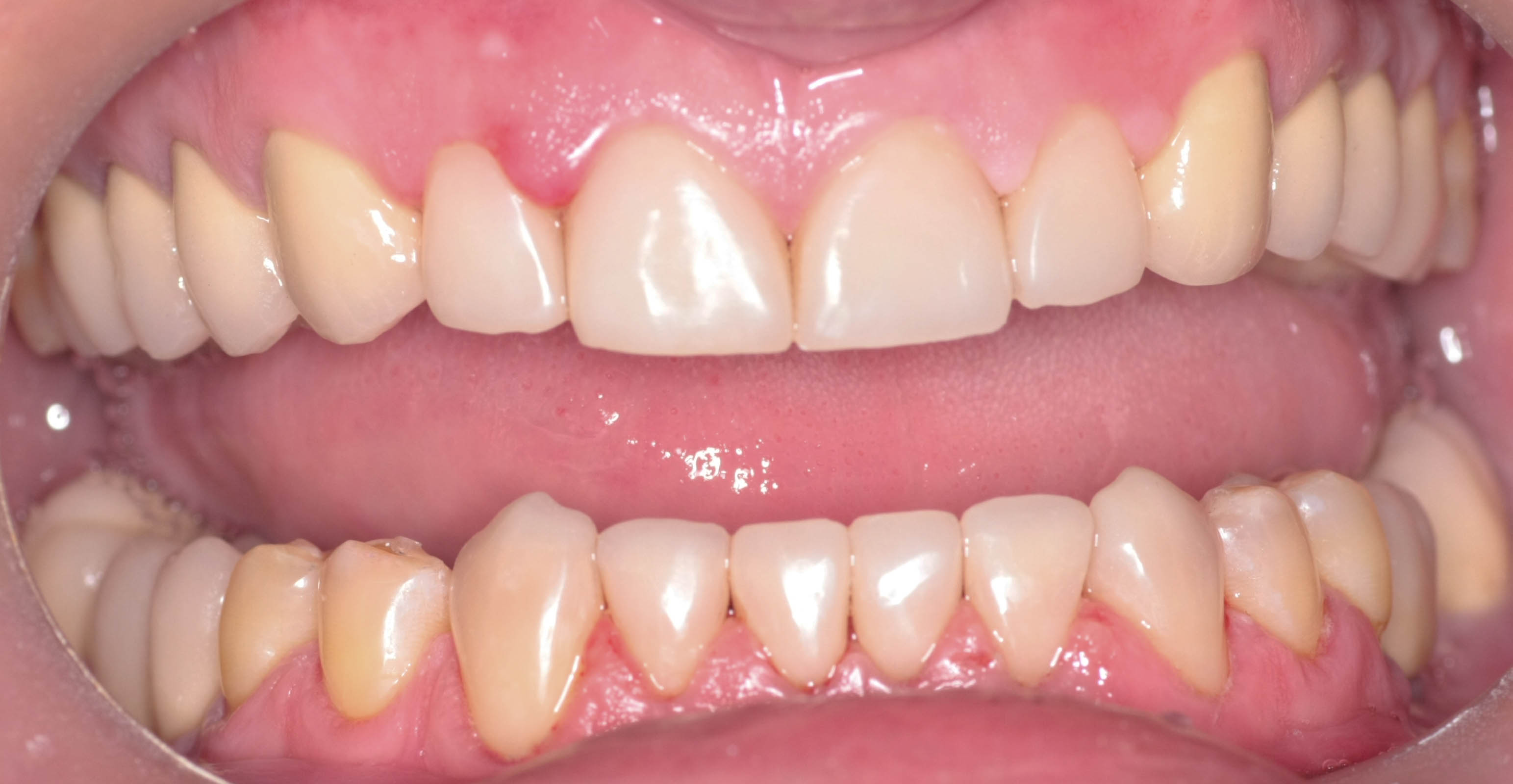 Реставрация зубов (после лечения)
