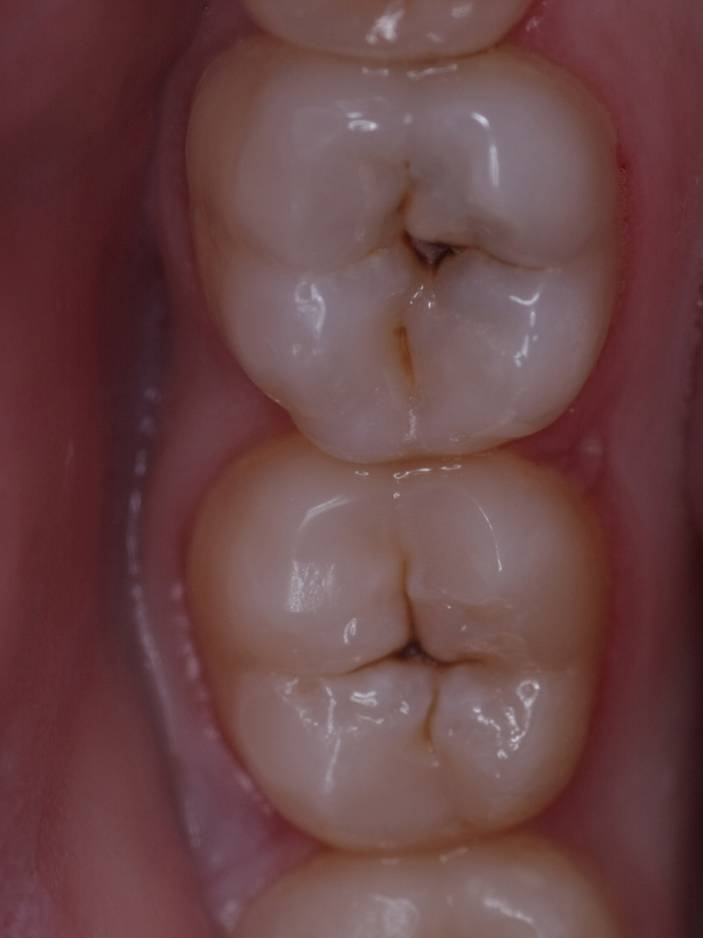 Чистка зубов (до лечения)