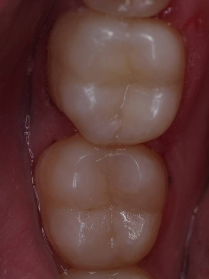 Чистка зубов (после лечения)